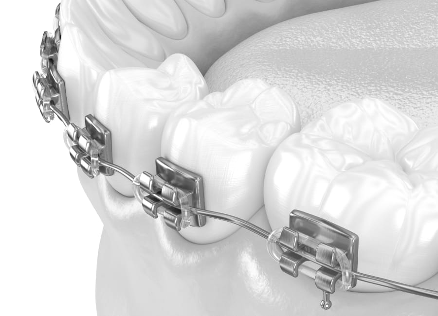 Traditional Metal Braces in Meridian and Laurel