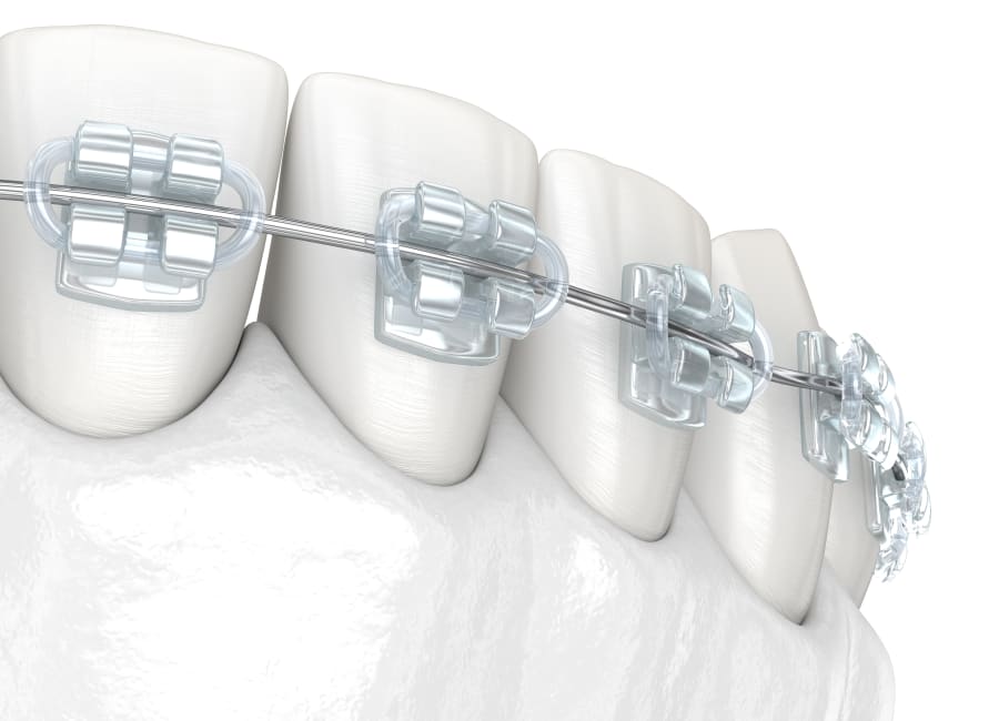 Translucent Metal Braces in Meridian and Laurel