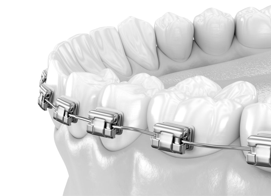 Self-Ligating Braces in Meridian and Laurel