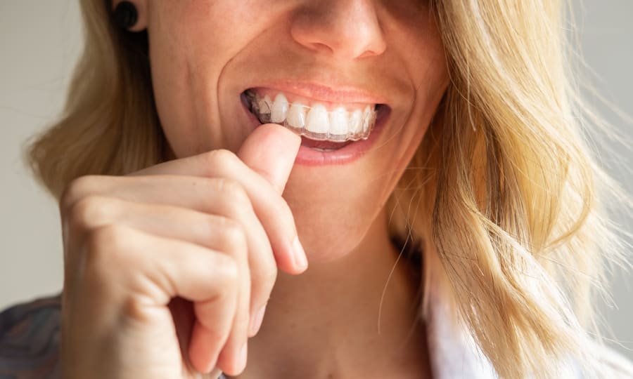 Invisalign Clear Aligners in Meridian and Laurel